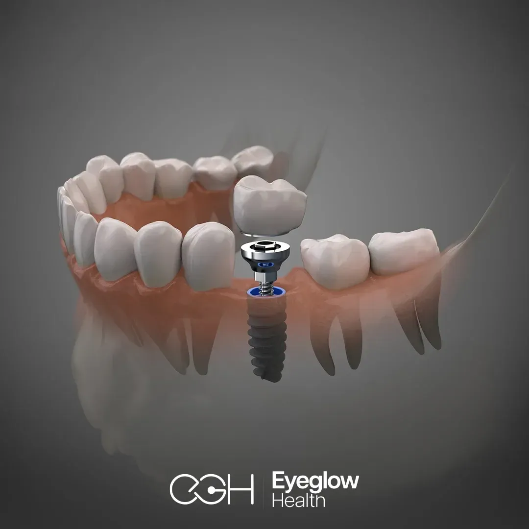 Dental implants at Eyeglow, Istanbul