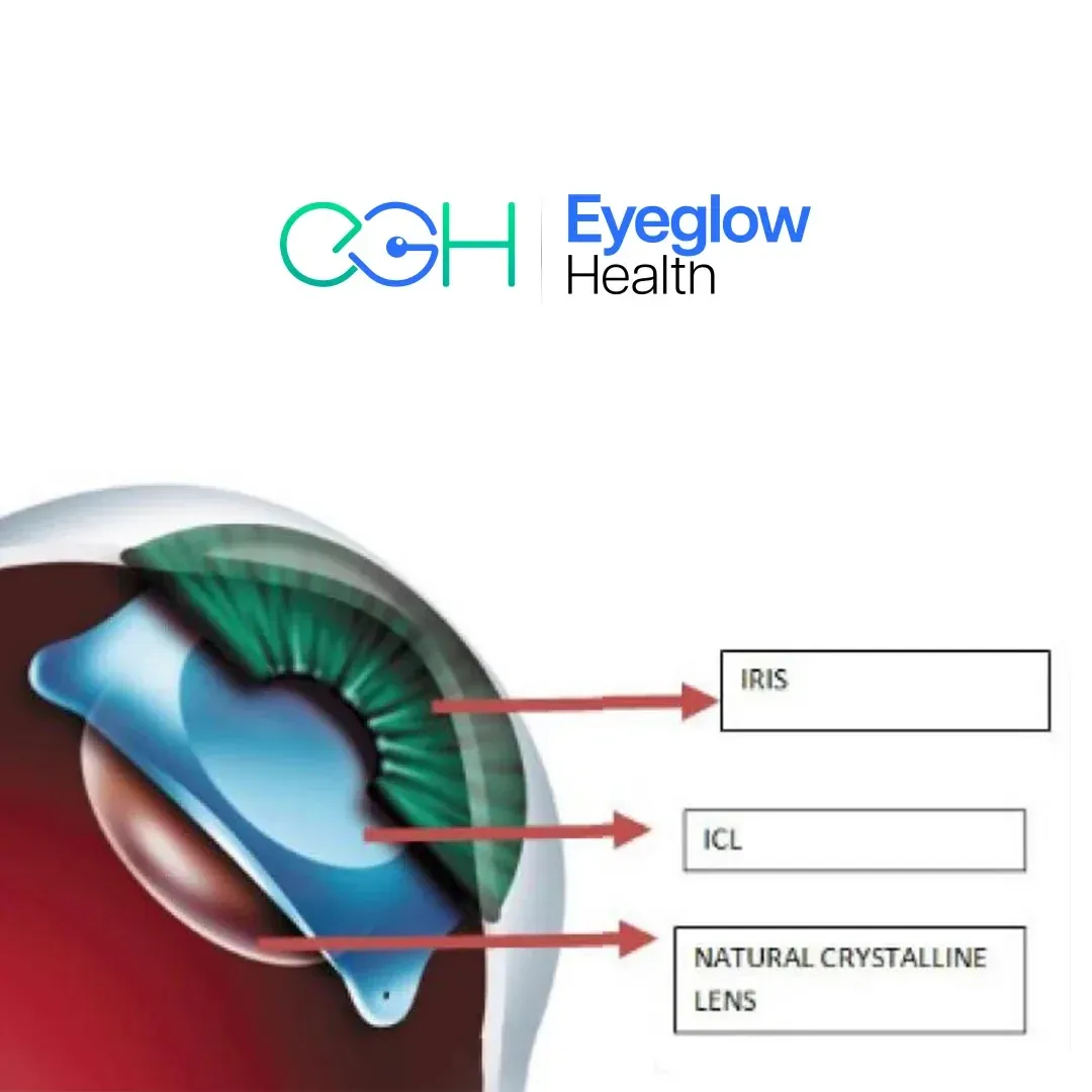 Cross-section diagram of an EVO ICL positioned between the iris and the natural crystalline lens — phakic lens implant surgery at Eyeglow Health, Istanbul