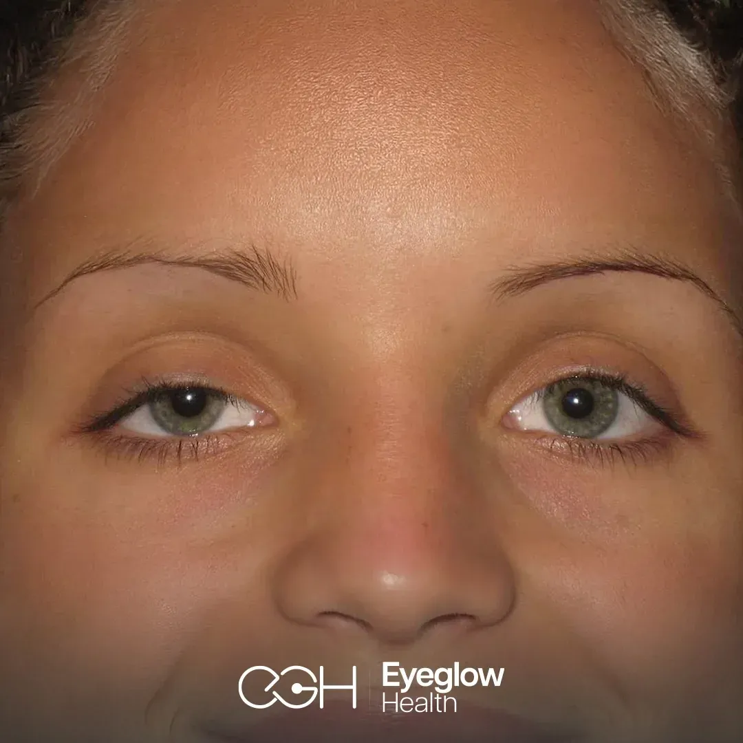 Close-up of a patient with a drooping upper eyelid — ptosis surgery at Eyeglow Health, Istanbul