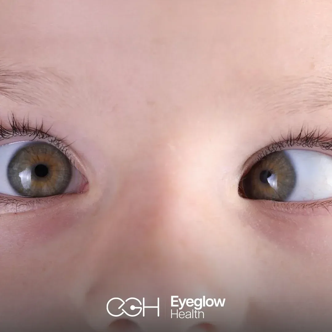 Close-up of a child with inward eye misalignment (esotropia) — strabismus surgery at Eyeglow Health, Istanbul
