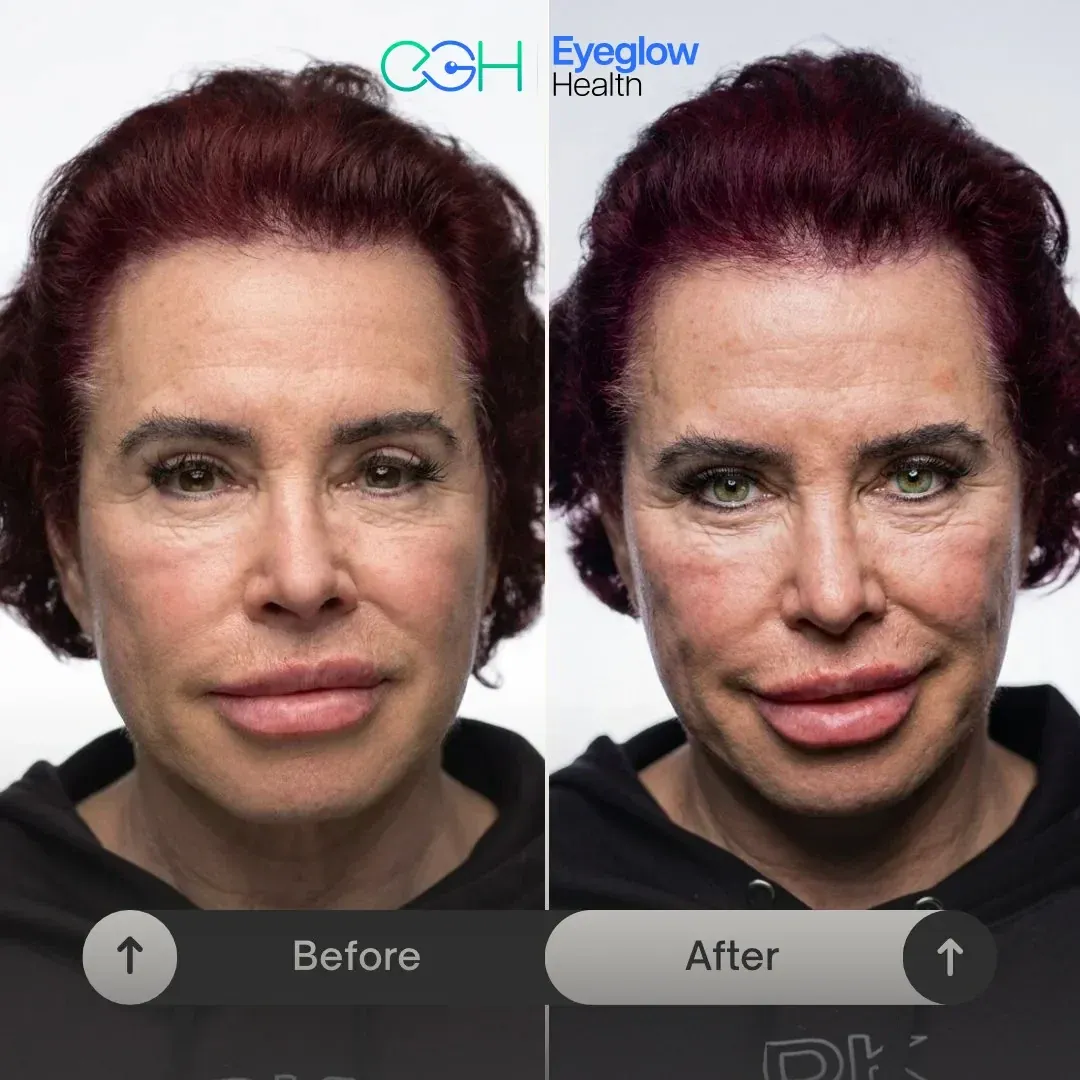 Patient before and after keratopigmentation eye colour change at Eyeglow Health, Istanbul