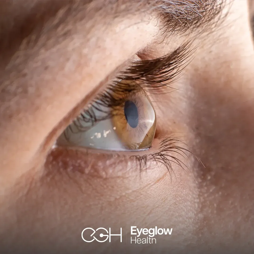 Cornea and keratoconus treatment at Eyeglow, Istanbul