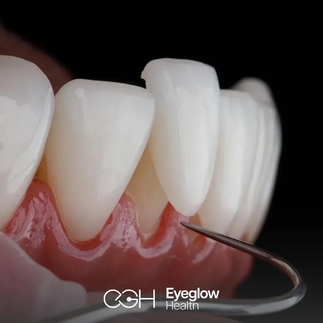 Veneers and smile design at Eyeglow, Istanbul