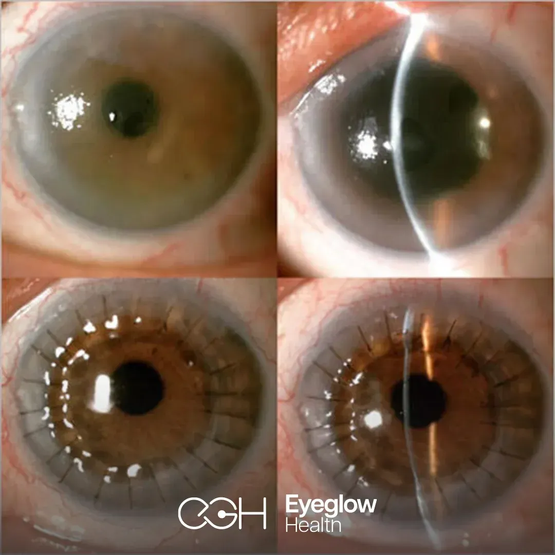 Slit-lamp views of a clouded cornea and a sutured donor graft after keratoplasty — Eyeglow Health, Istanbul