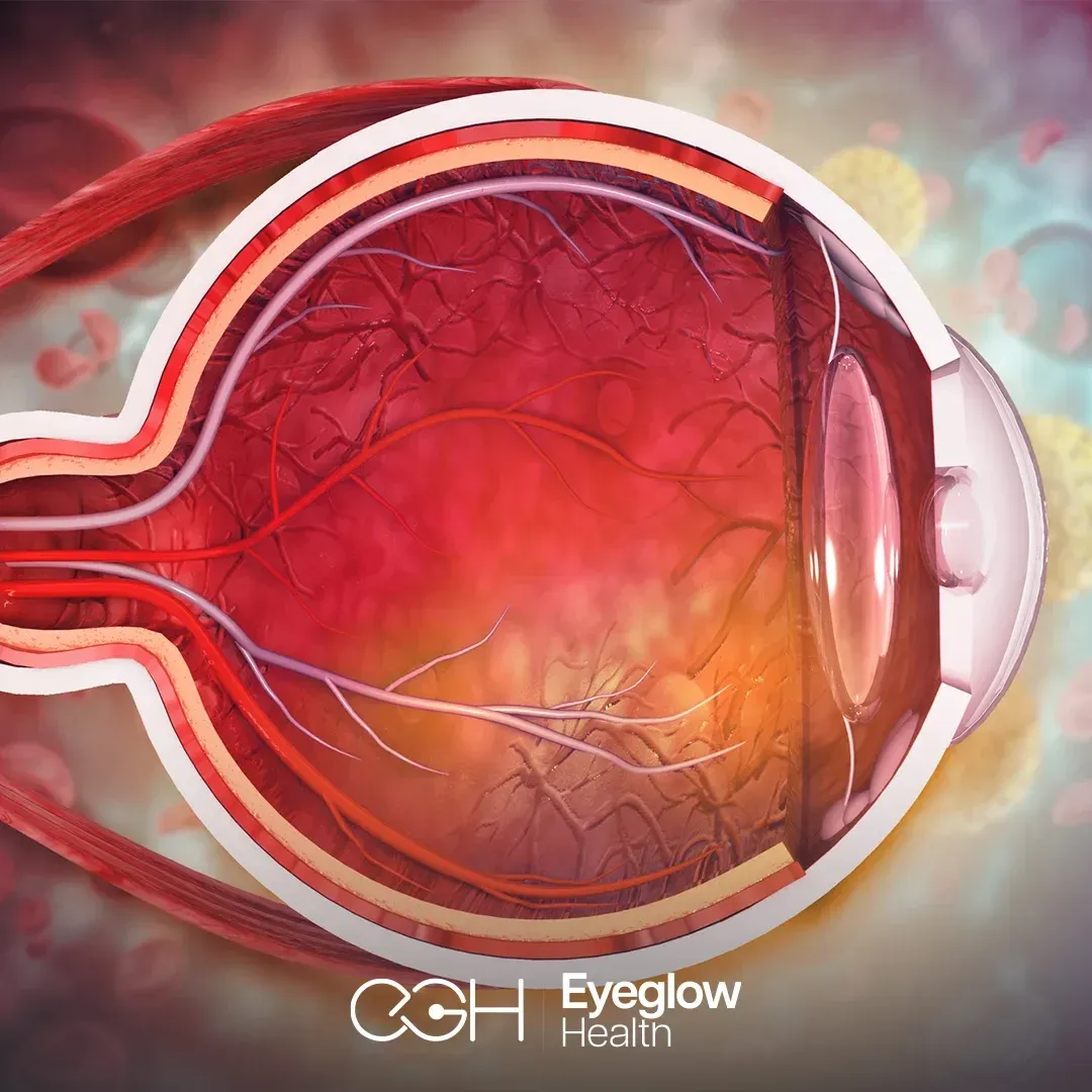Eye stem cell therapy at Eyeglow, Istanbul
