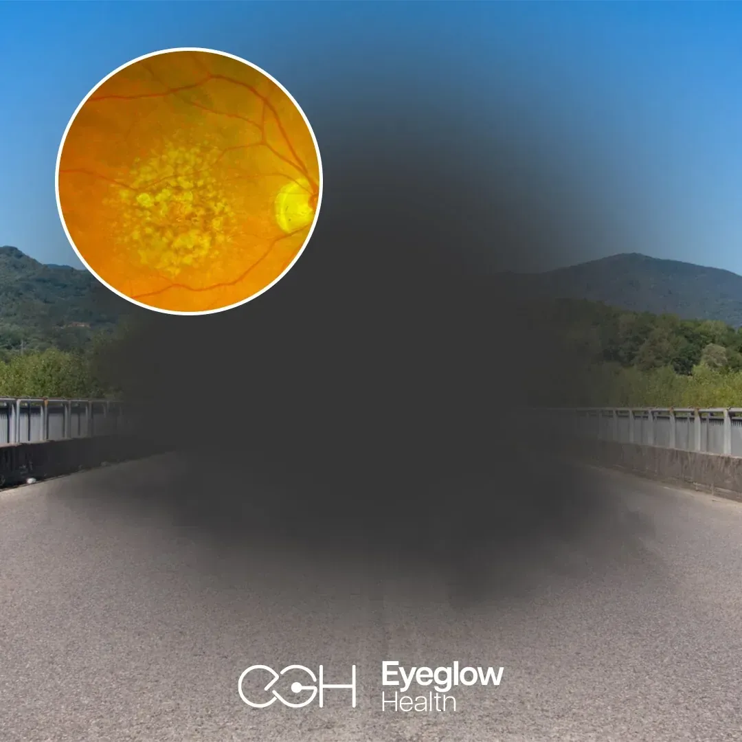 Simulated central vision loss over a road scene, with an inset fundus photograph showing drusen at the macula — age-related macular degeneration treatment at Eyeglow Health, Istanbul