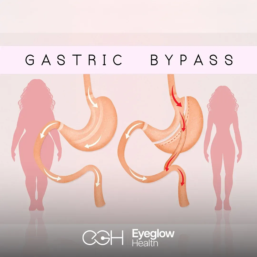 Gastric bypass surgery at Eyeglow, Istanbul