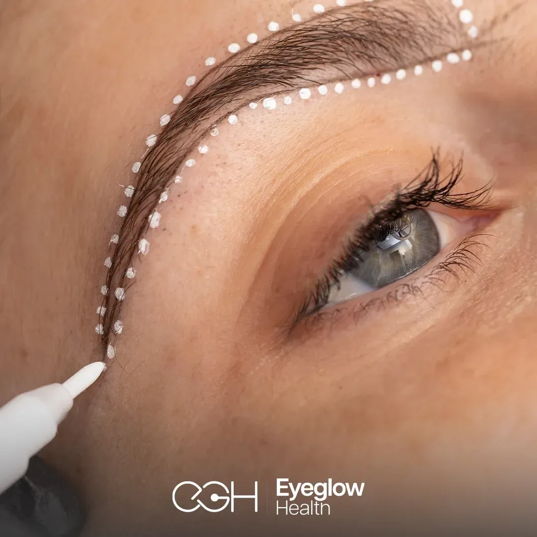Eyebrow transplant at Eyeglow, Istanbul