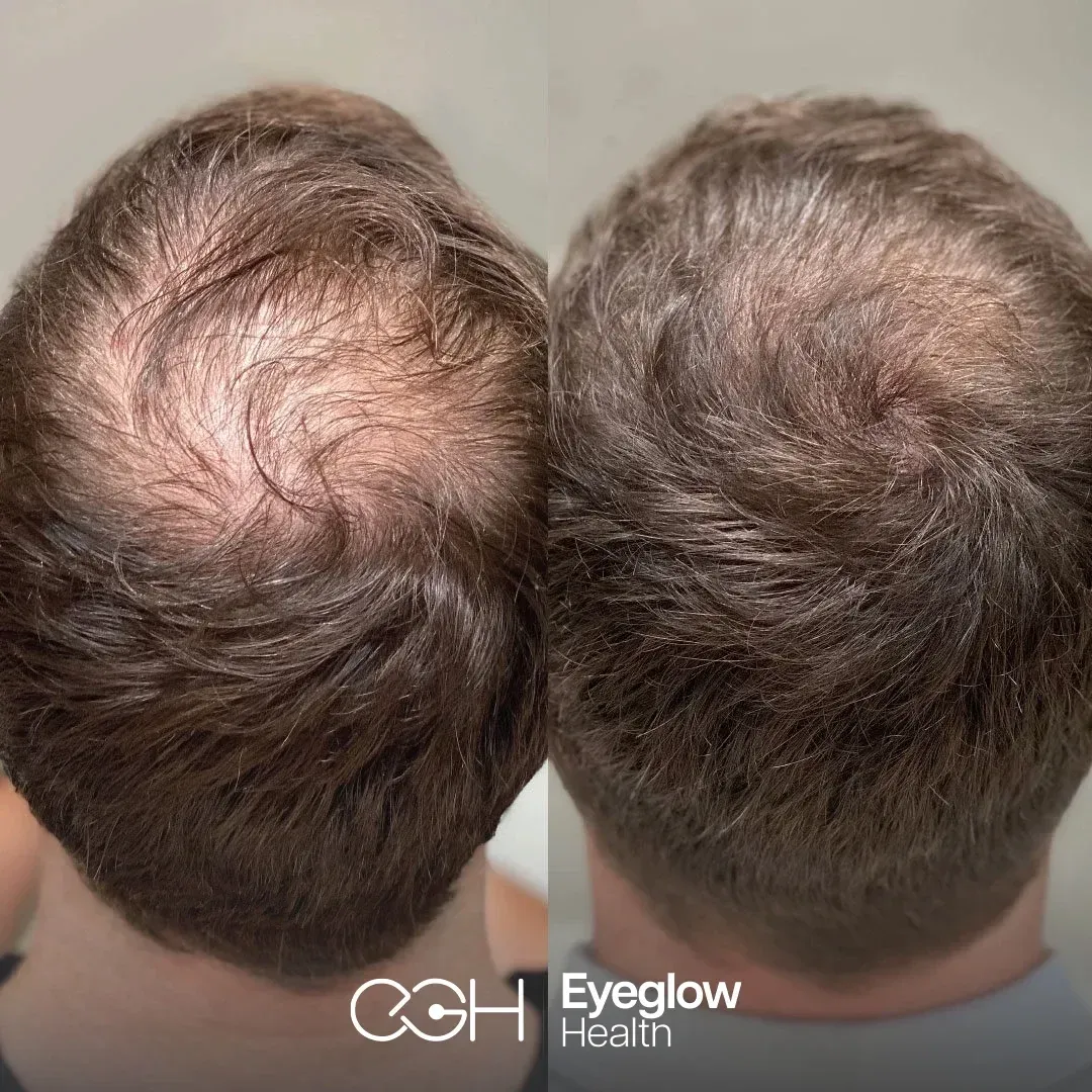 Hair PRP and mesotherapy at Eyeglow, Istanbul