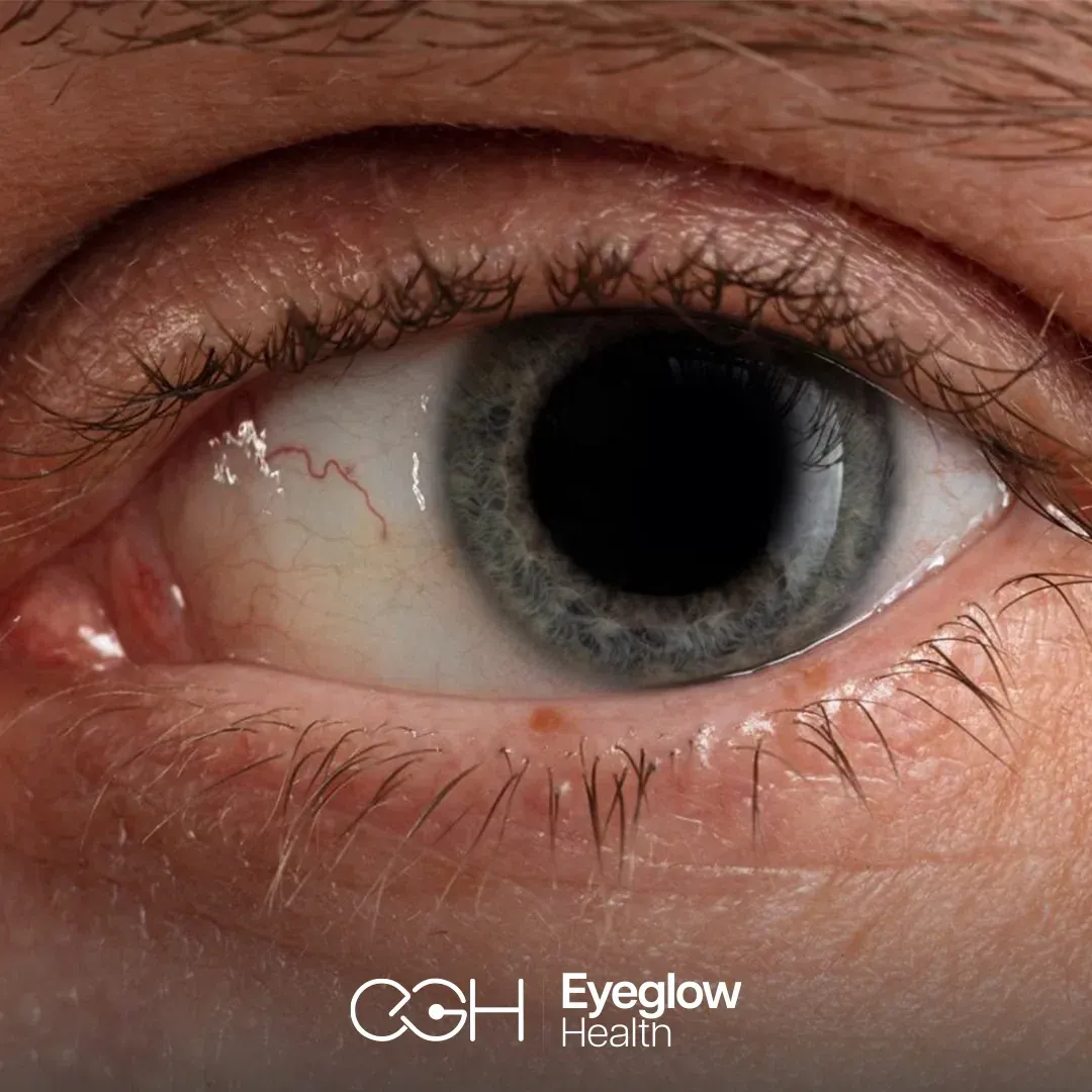 Close-up of a human eye — glaucoma assessment and surgery at Eyeglow Health, Istanbul
