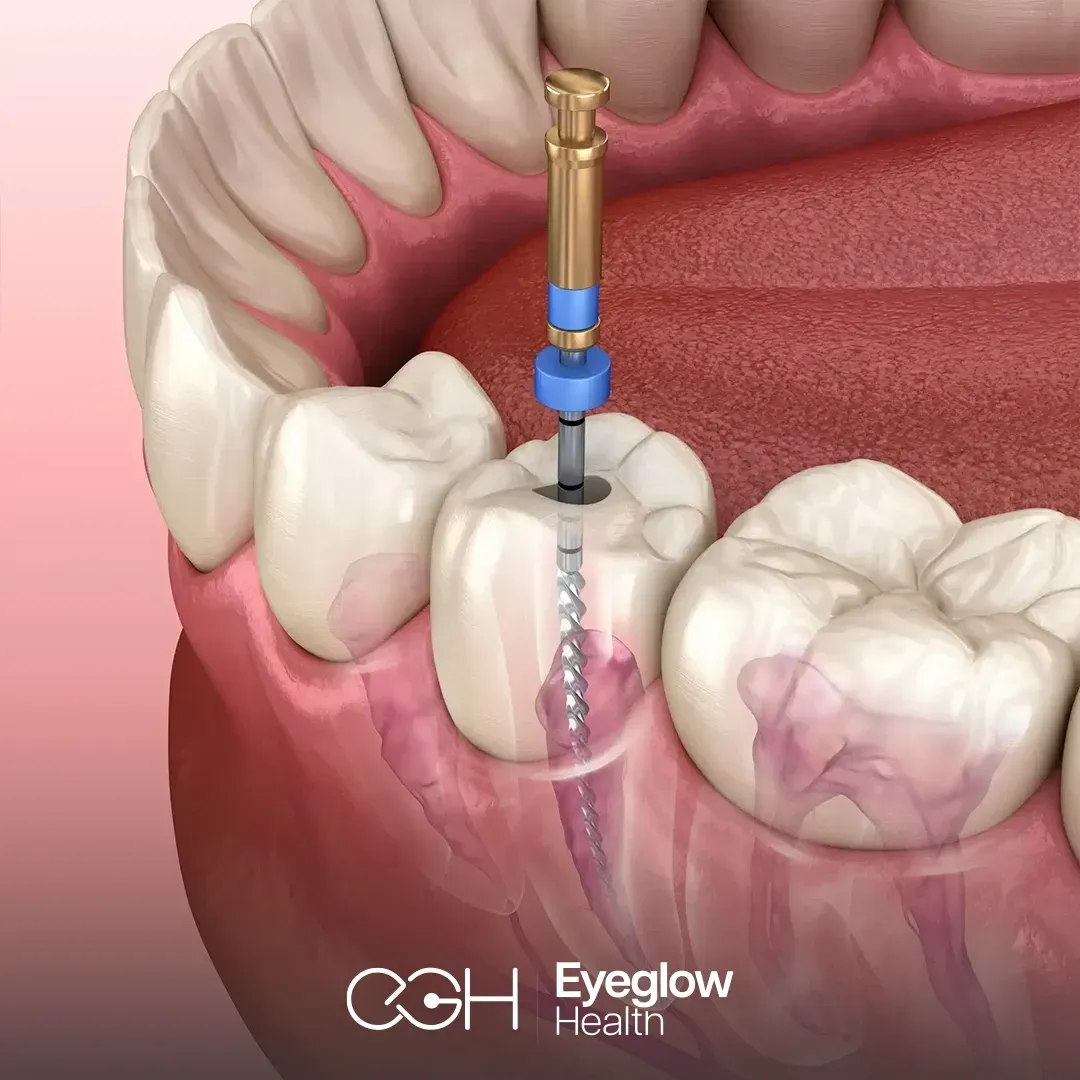 Root canal treatment at Eyeglow, Istanbul