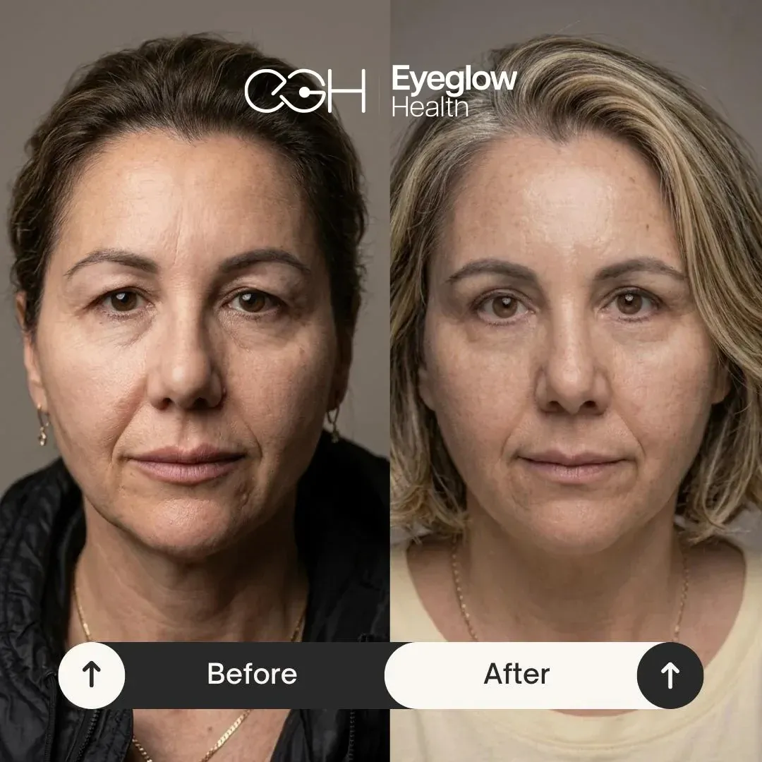 Patient before and after blepharoplasty (eyelid surgery) at Eyeglow Health, Istanbul