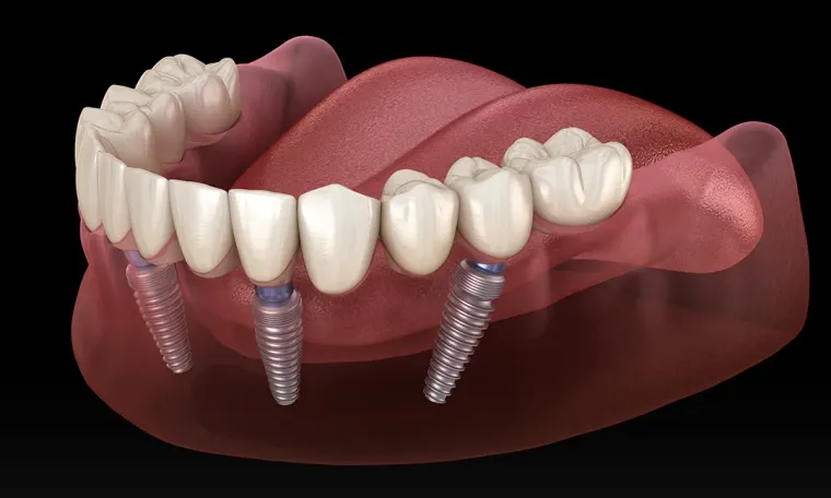 All-on-4 Implants