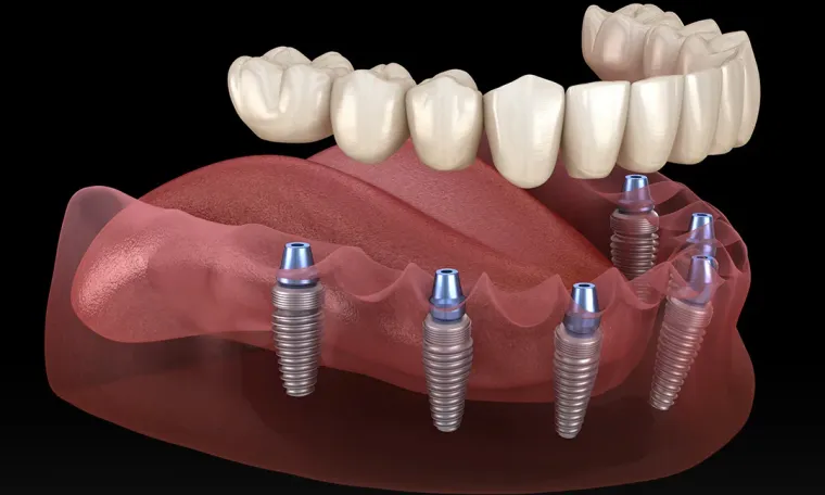 All-on-6 Implants