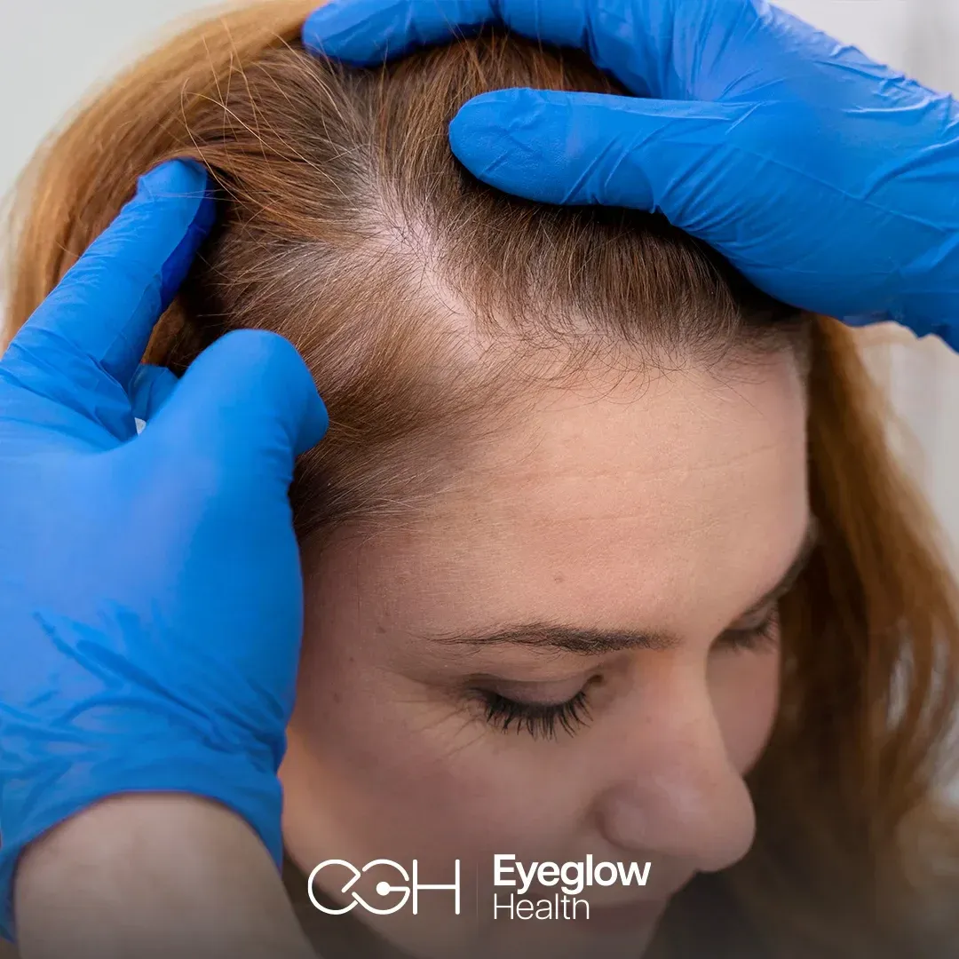 Female hair transplant at Eyeglow, Istanbul