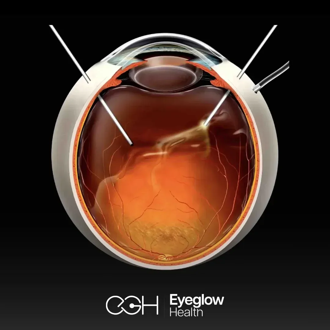 Retinal vitrectomy at Eyeglow, Istanbul