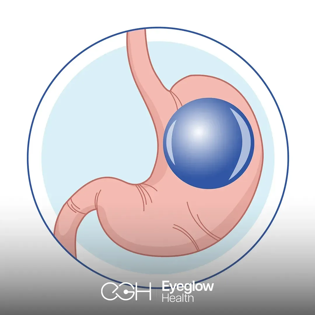 Gastric balloon at Eyeglow, Istanbul