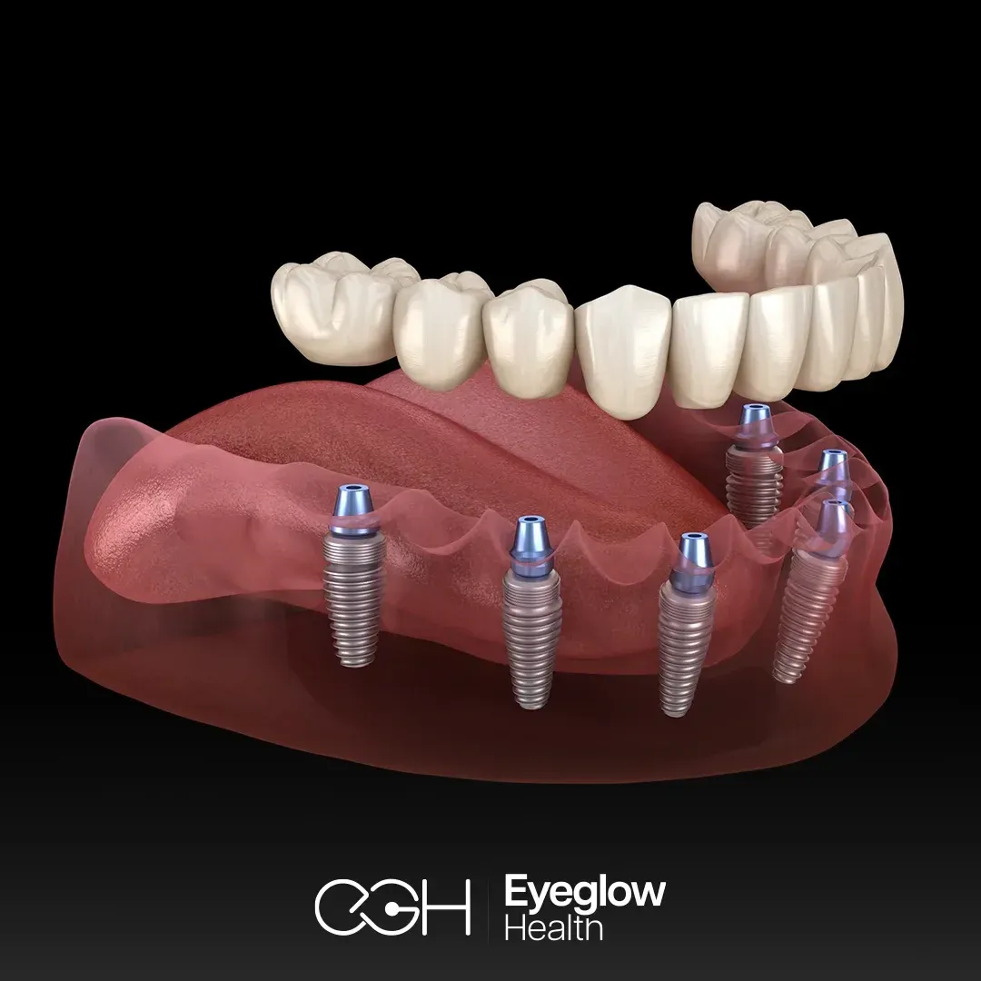 All-on-6 implants at Eyeglow, Istanbul
