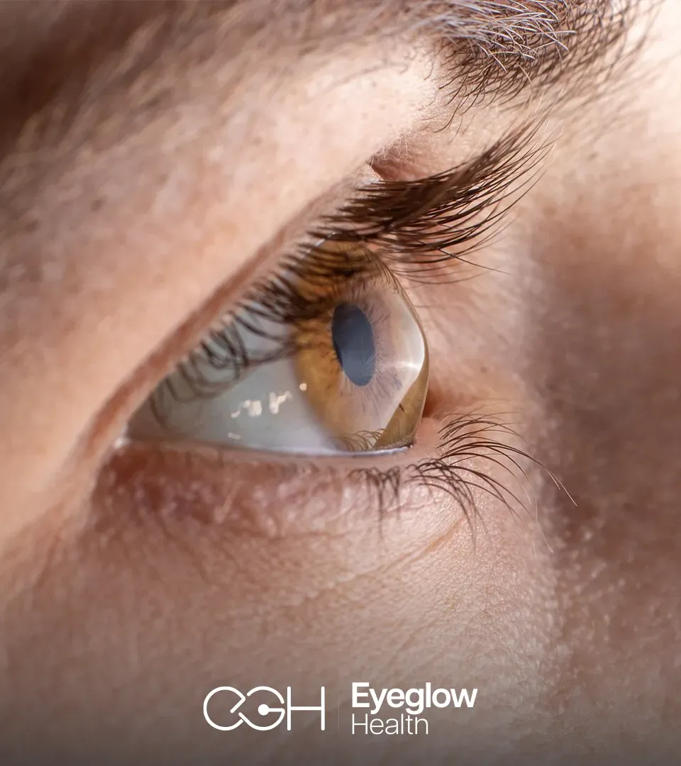 Keratoconus treatment and corneal cross-linking at Eyeglow Health, Istanbul