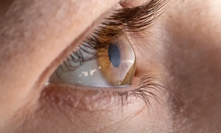 Cornea & Keratoconus