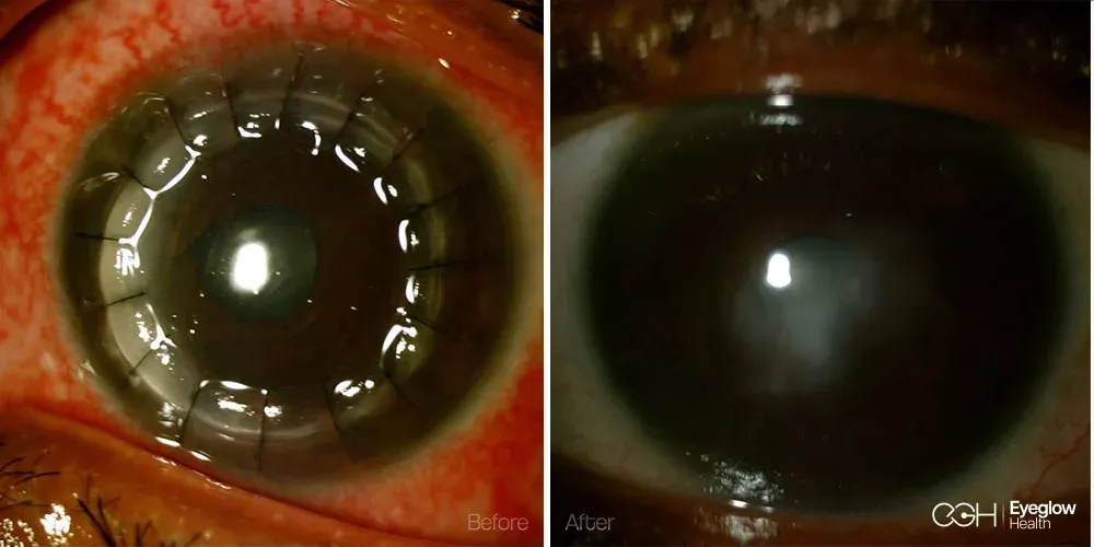 Corneal transplant (keratoplasty) managed by the Eyeglow Health surgical team in Istanbul — before and after graft healing