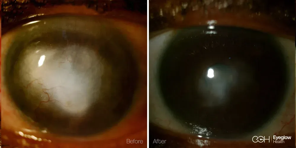 Penetrating keratoplasty with sutured donor graft managed by the Eyeglow Health surgical team in Istanbul — before and after