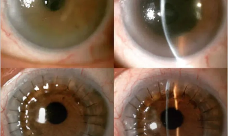 Corneal Transplant (Keratoplasty)