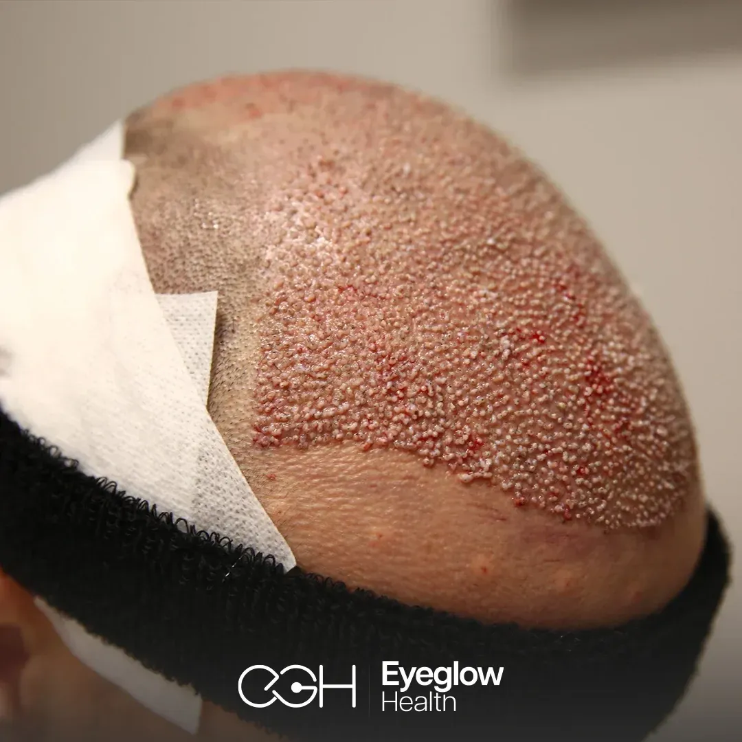 FUE hair transplant at Eyeglow, Istanbul