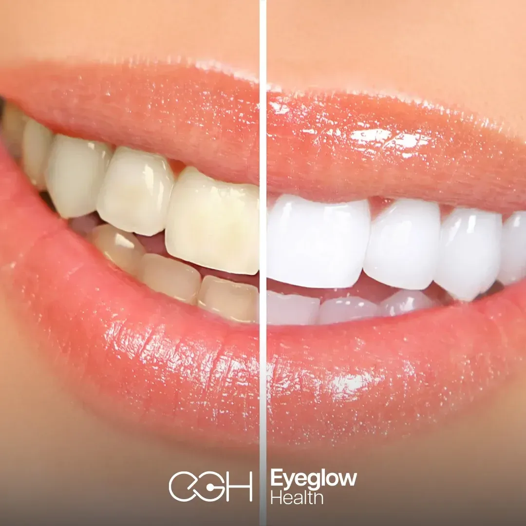 Teeth whitening at Eyeglow, Istanbul