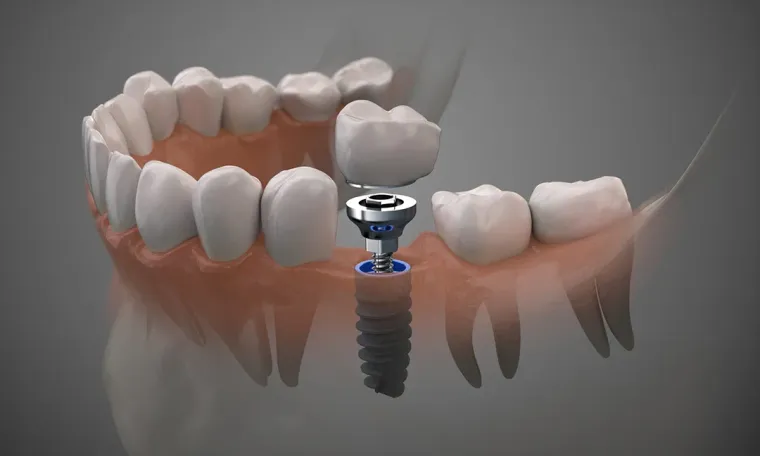 Dental Implants