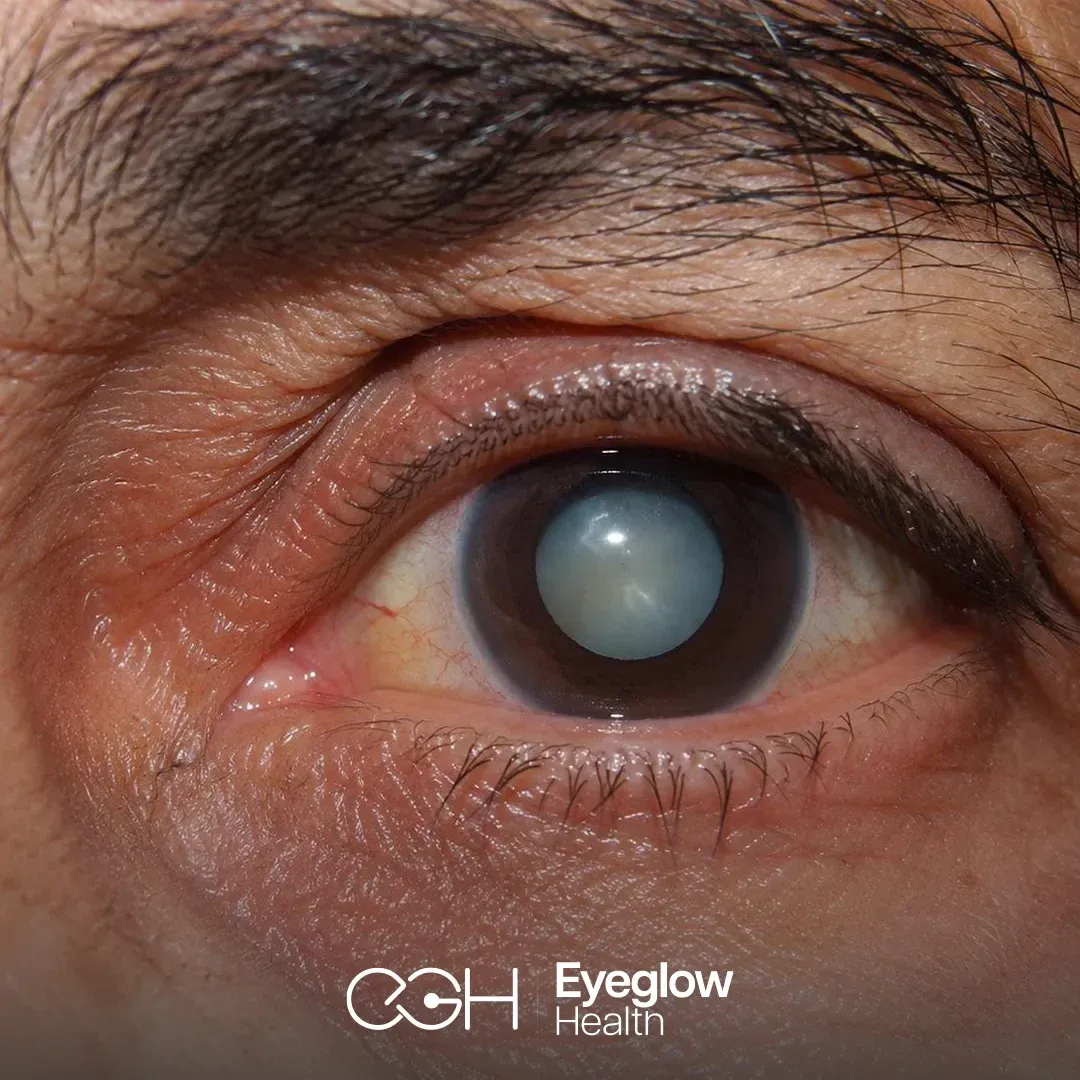 Smart Lens and cataract surgery at Eyeglow, Istanbul