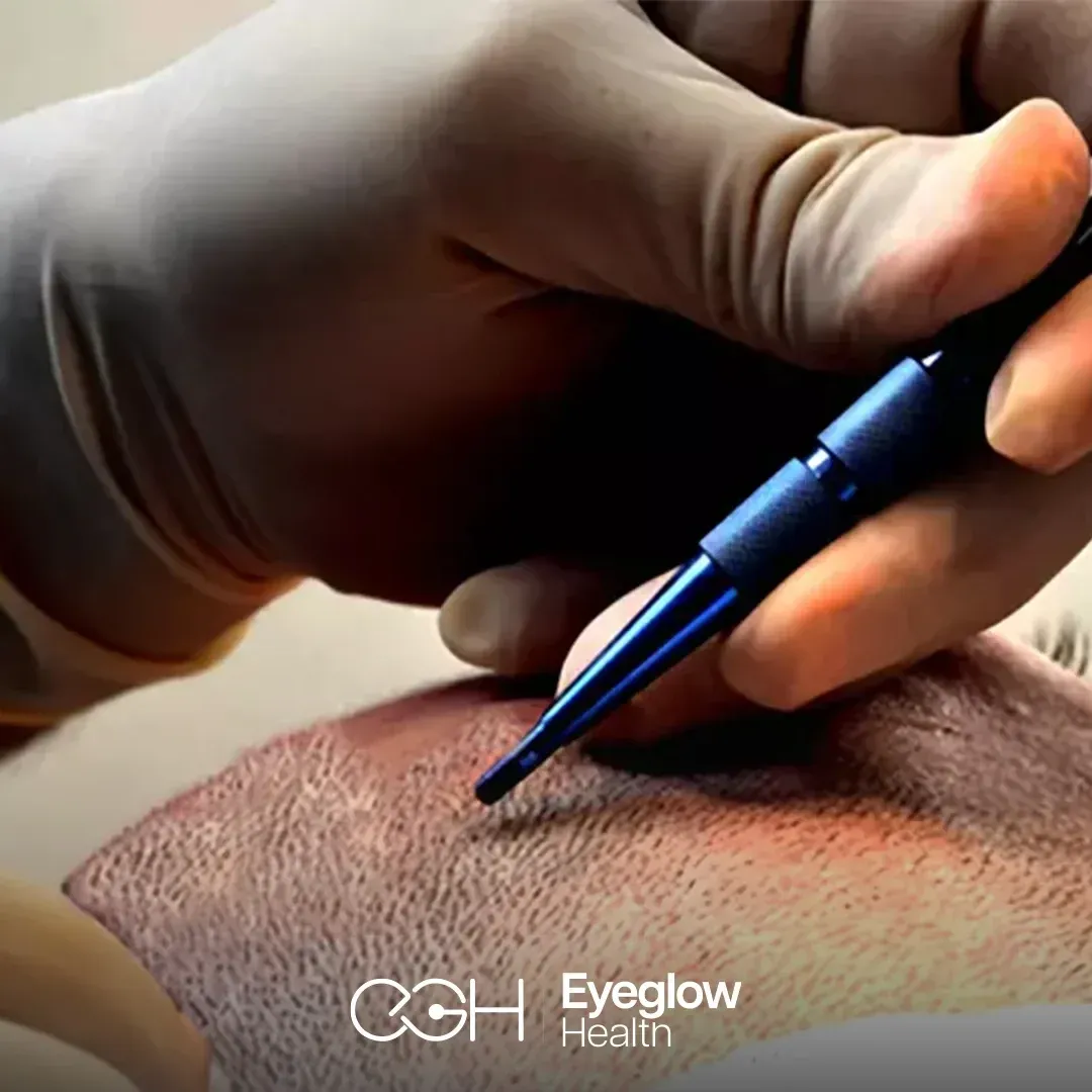 Sapphire FUE hair transplant at Eyeglow, Istanbul