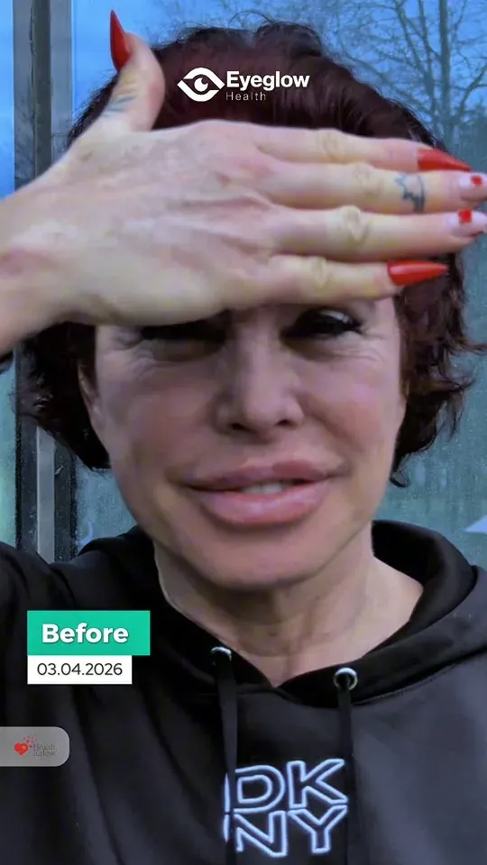 Silvia Cristina Guidi De Knappe — Keratopigmentation
