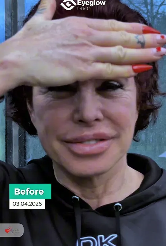 Silvia Cristina Guidi De Knappe — Keratopigmentation patient story