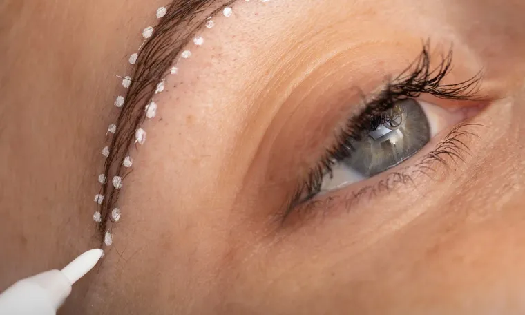 Eyebrow Transplant