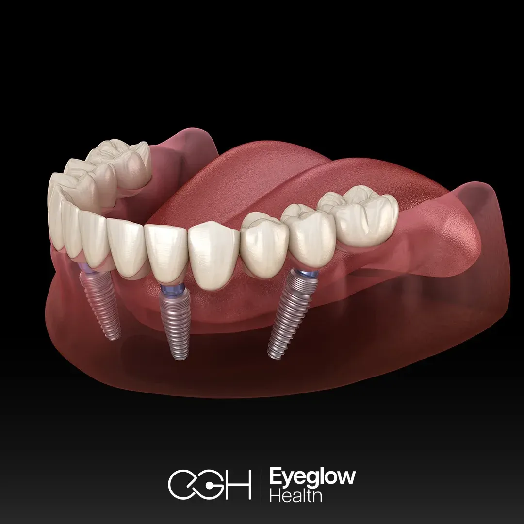 All-on-4 implants at Eyeglow, Istanbul