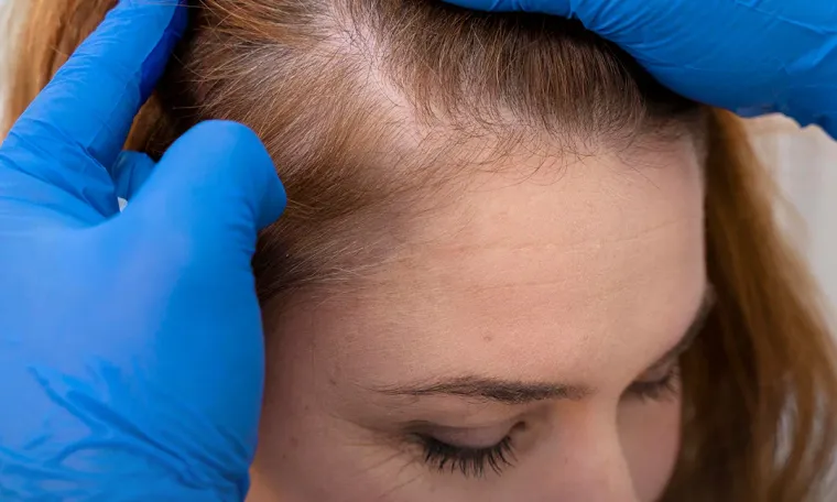 Female Hair Transplant