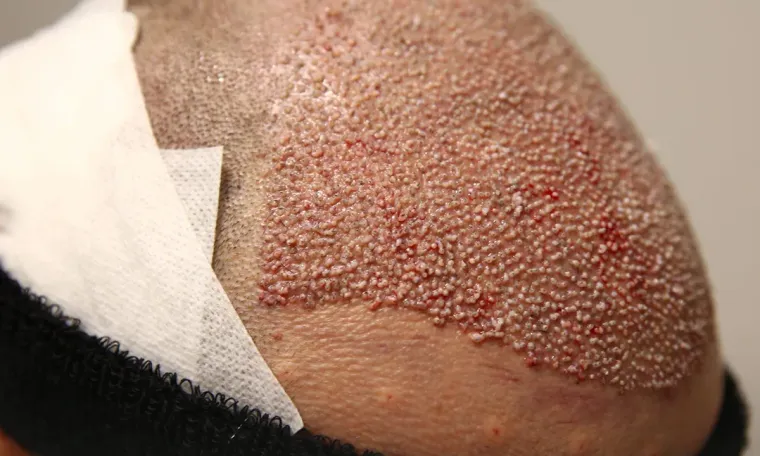 FUE Hair Transplant