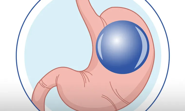 Gastric Balloon