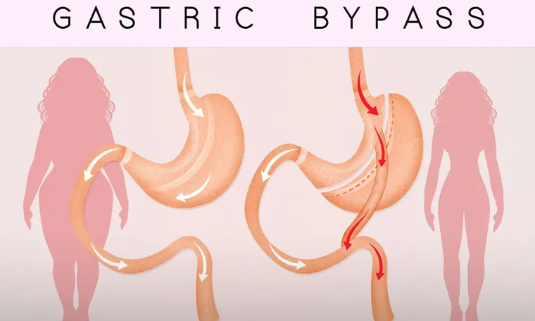 Gastric Bypass