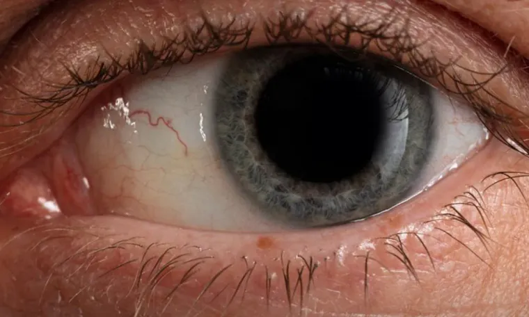 Glaucoma Surgery