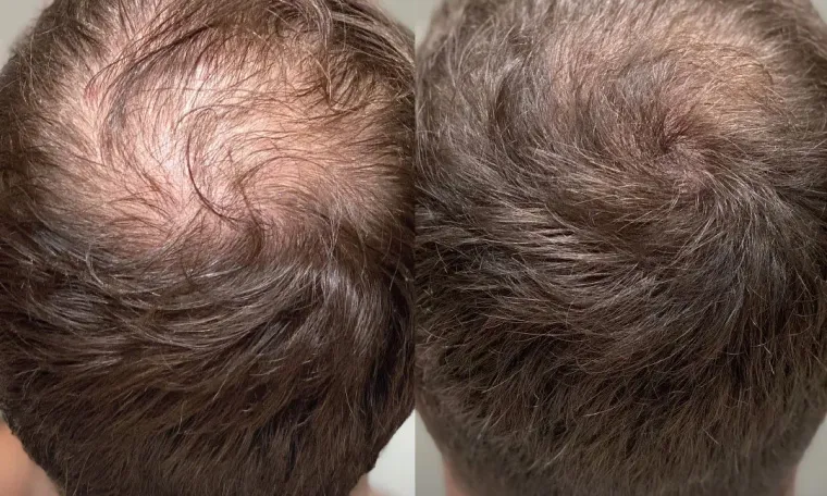 Hair PRP & Mesotherapy