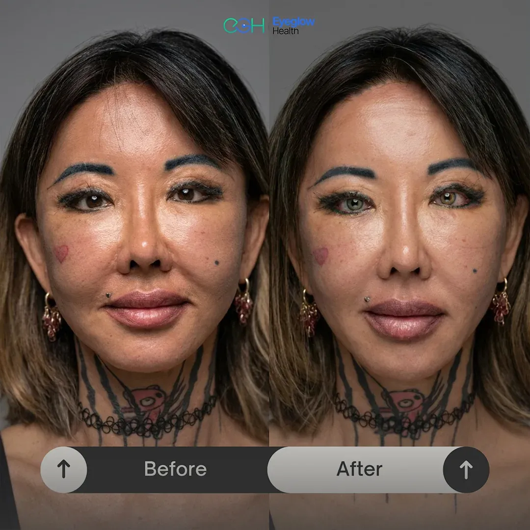 Keratopigmentation patient at Eyeglow Health, Istanbul — side-by-side before and after images showing dark brown irides changed to two different tones, one eye grey-blue and the other green