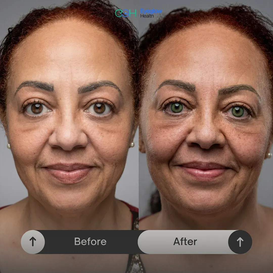 Keratopigmentation patient at Eyeglow Health, Istanbul — side-by-side before and after images showing brown irides changed to a green tone
