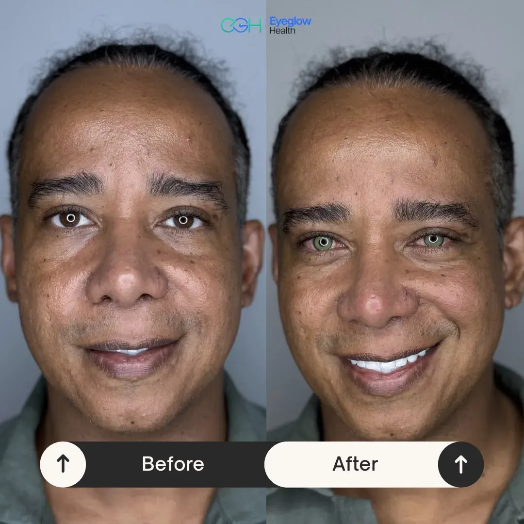 Keratopigmentation patient at Eyeglow Health, Istanbul — side-by-side before and after images showing dark brown irides changed to a green tone in both eyes
