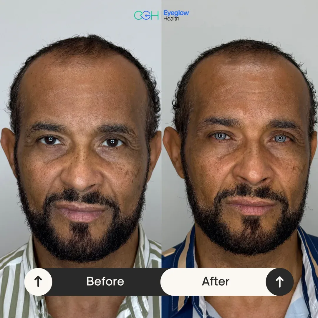 Keratopigmentation patient at Eyeglow Health, Istanbul — side-by-side before and after images showing dark brown irides changed to a grey-blue tone in both eyes