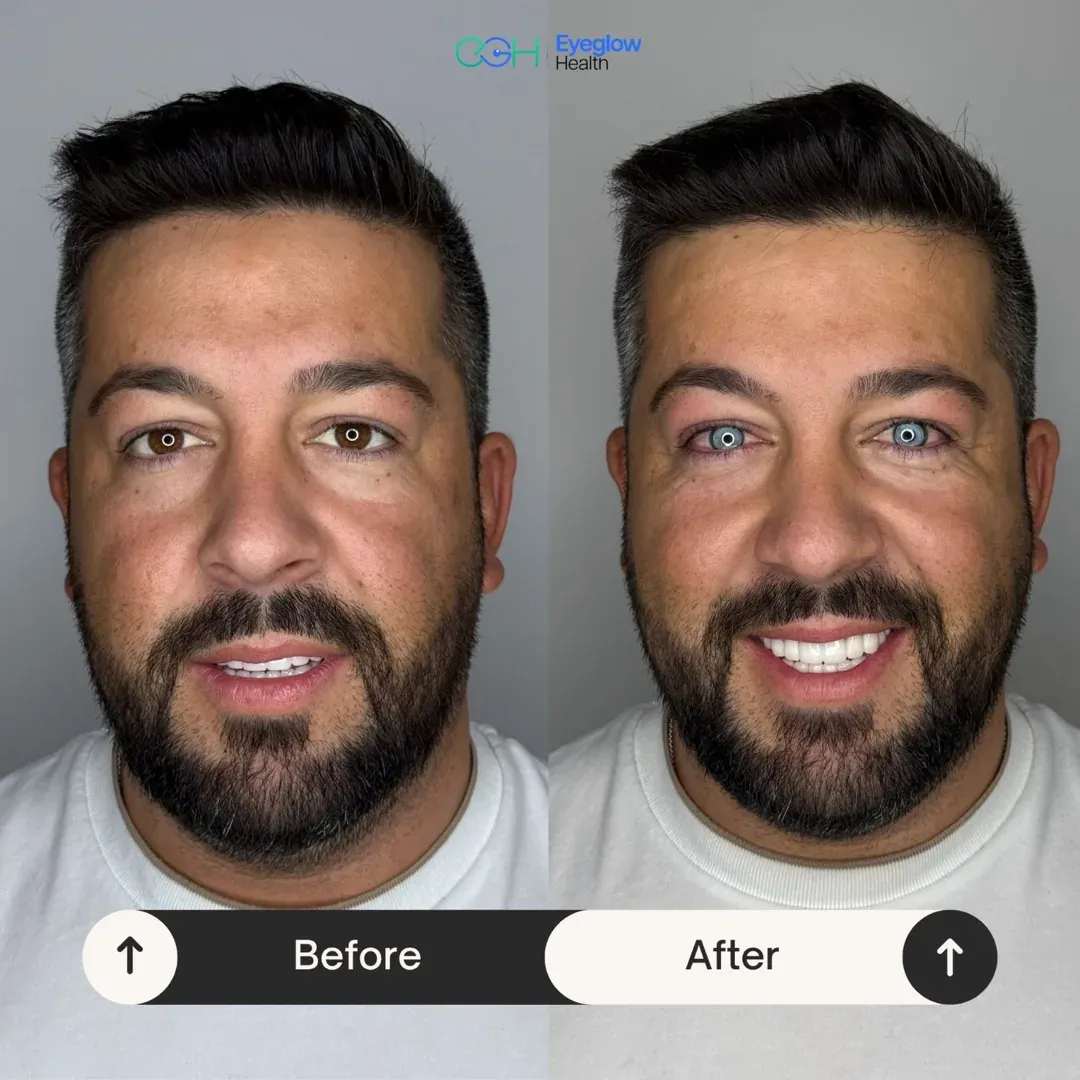 Keratopigmentation patient at Eyeglow Health, Istanbul — side-by-side before and after images showing dark brown irides changed to a light blue tone in both eyes