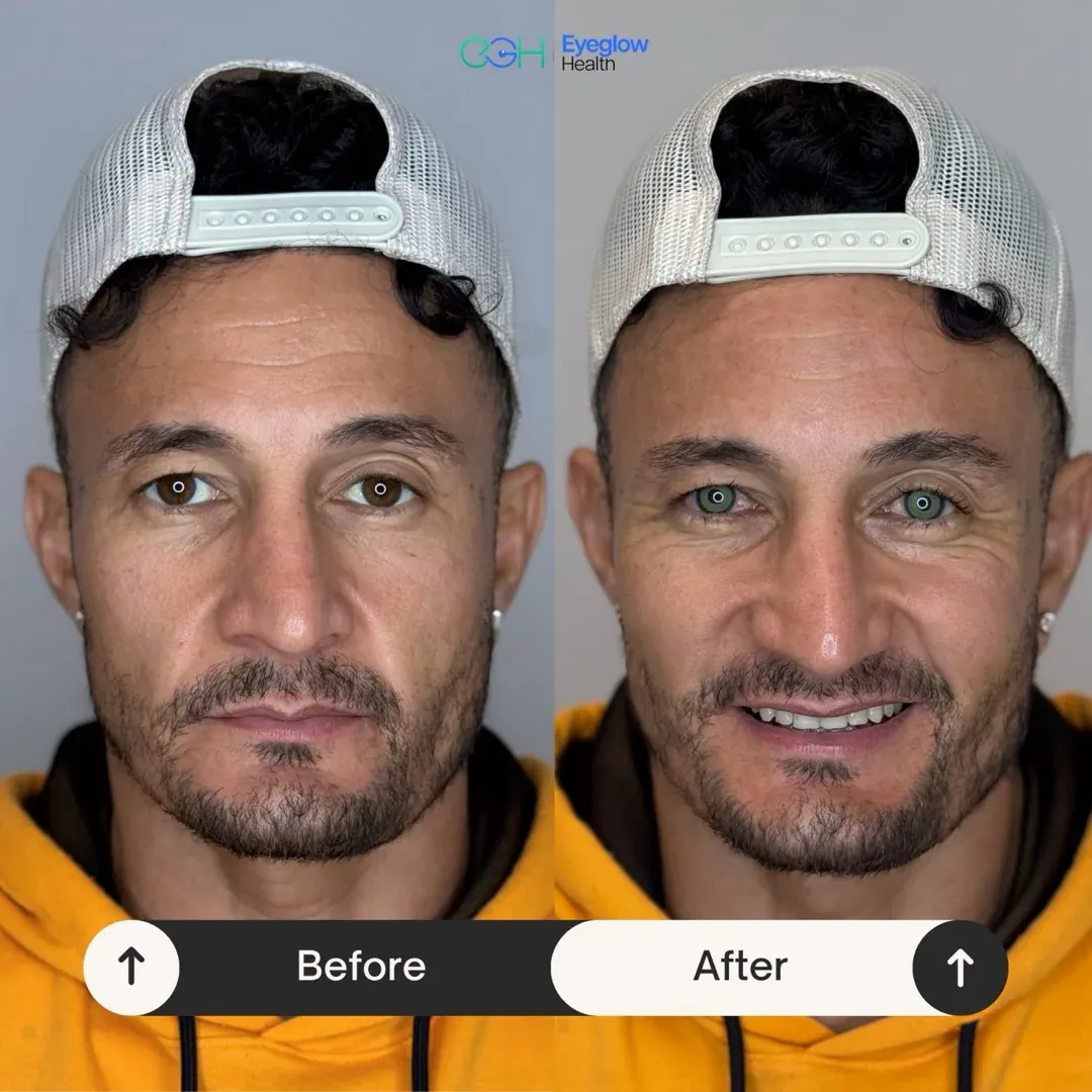 Keratopigmentation patient at Eyeglow Health, Istanbul — side-by-side before and after images showing brown irides changed to a grey-green tone in both eyes