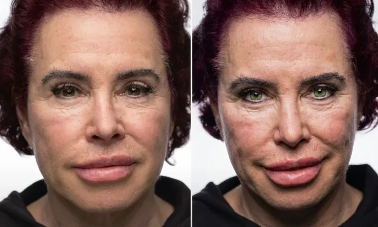 Keratopigmentation