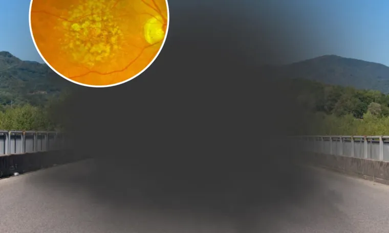 Macular Degeneration